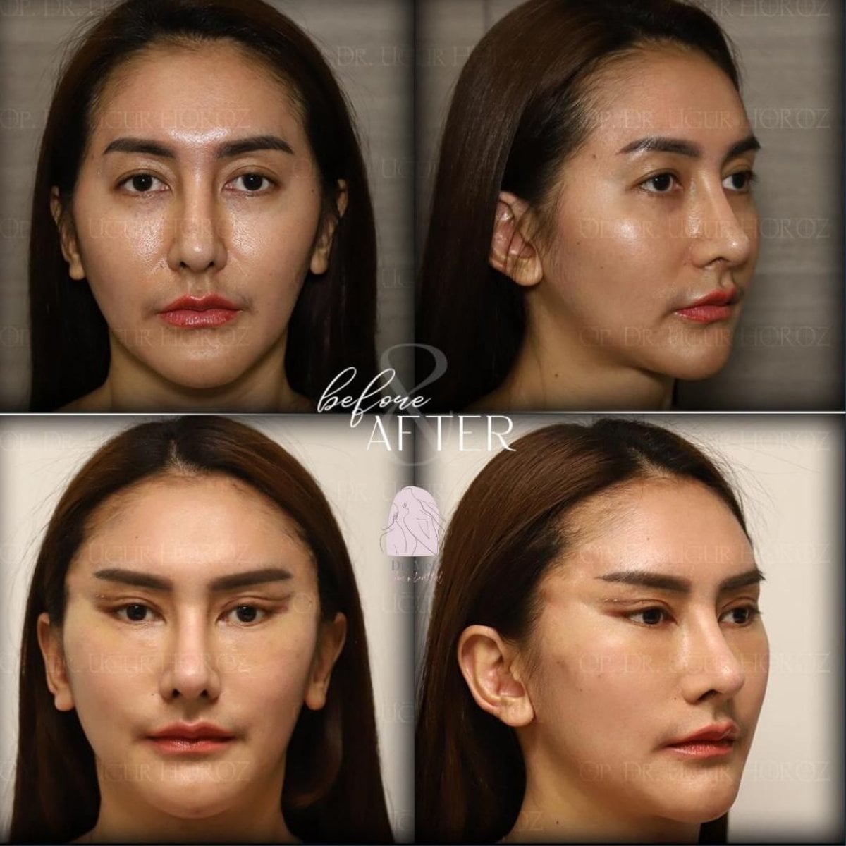 Resultados de lifting facial antes y después en Dr. MED – contorno facial rejuvenecido