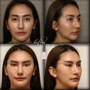 Résultats lifting visage avant/après chez Dr. MED – contours liftés et rajeunis