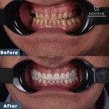 Hollywood Smile before and after results at Dentavie Istanbul Dental Clinic, smile makeover