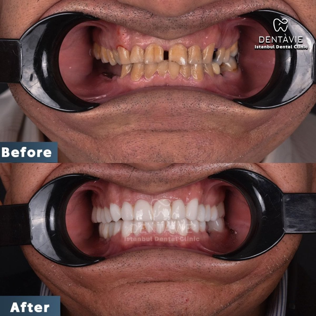 نتائج قبل وبعد ابتسامة هوليود في Dentavie Istanbul Dental Clinic، تغيير الابتسامة
