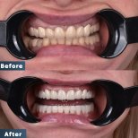 Resultados antes y después de Hollywood Smile en Dentavie Istanbul Dental Clinic, dientes blancos