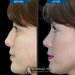 Resultados de rinoplastia antes y después en Dr. Safa Manav Clinic, perfil nasal mejorado