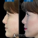 Resultados de rinoplastia antes y después en Dr. Safa Manav Clinic, perfil nasal mejorado