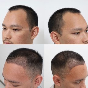 Before and after hair transplant results at Wansiri Hospital, improved hairline and density