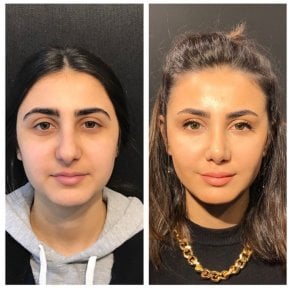 Vorher-nachher-Ergebnis der Bichat-Fettentfernung in Prof. Furkan Karabekmez Klinik