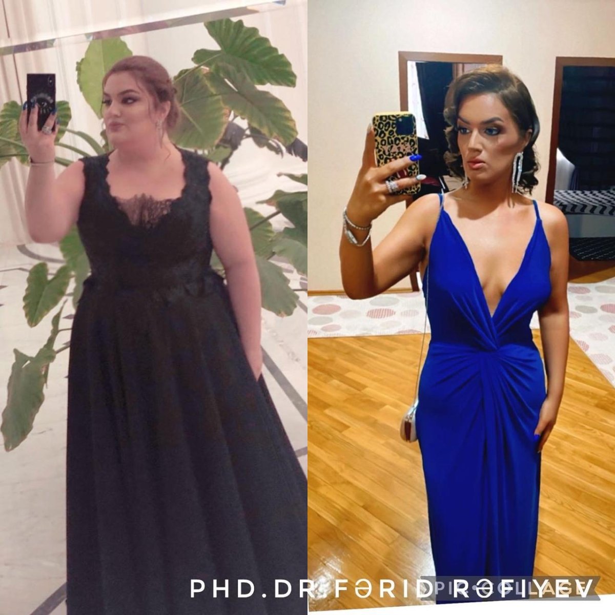 До и после операции рукавной гастрэктомии в Liv Bona Dea Hospital Baku, видимый результат