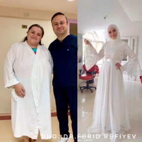 Resultados antes y después de manga gástrica en Liv Bona Dea Hospital Baku, pérdida de peso visible