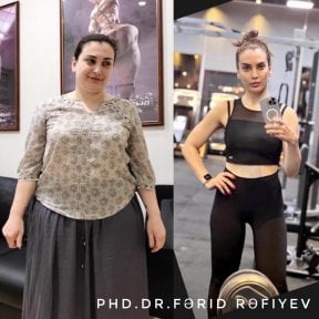 Resultados antes y después de manga gástrica en Liv Bona Dea Hospital Baku, pérdida de peso visible