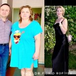 Antes y después de manga gástrica en Liv Bona Dea Hospital Baku – resultado de pérdida de peso