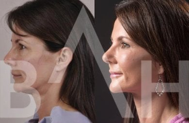Facelift before and after results at Büyük Anadolu Hospitals (BAH), visible facial rejuvenation
