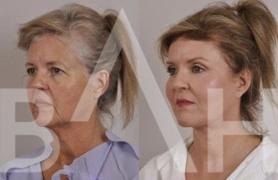Résultats lifting visage avant/après à Büyük Anadolu Hospitals (BAH), rajeunissement visible