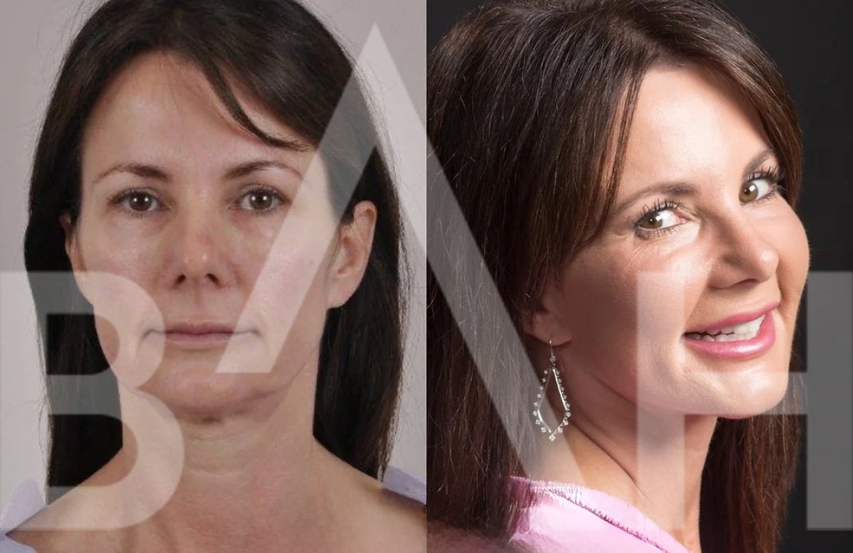 Before and after deep plane facelift results at Büyük Anadolu Hospitals (BAH), facial rejuvenation