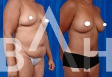Mommy makeover before and after results at Büyük Anadolu Hospitals (BAH), body contour improved