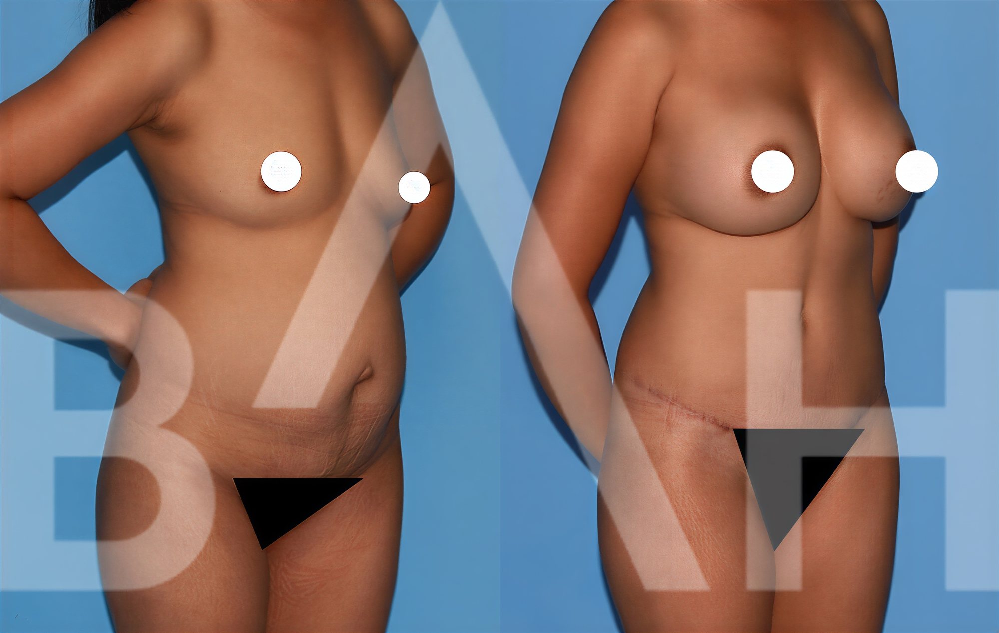 Resultados antes y después de mommy makeover en Büyük Anadolu Hospitals (BAH), contorno corporal