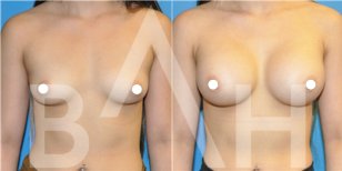 Результати до і після збільшення грудей з підтяжкою у Büyük Anadolu Hospitals (BAH)