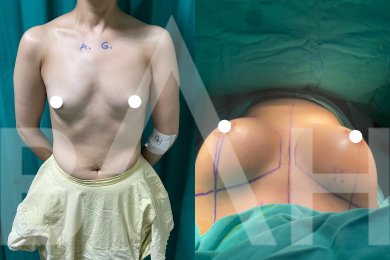 До та після імплантації грудей з підтяжкою в Büyük Anadolu Hospitals (BAH), покращена форма