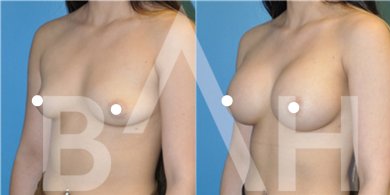 Результати до і після збільшення грудей з підтяжкою в Büyük Anadolu Hospitals (BAH)