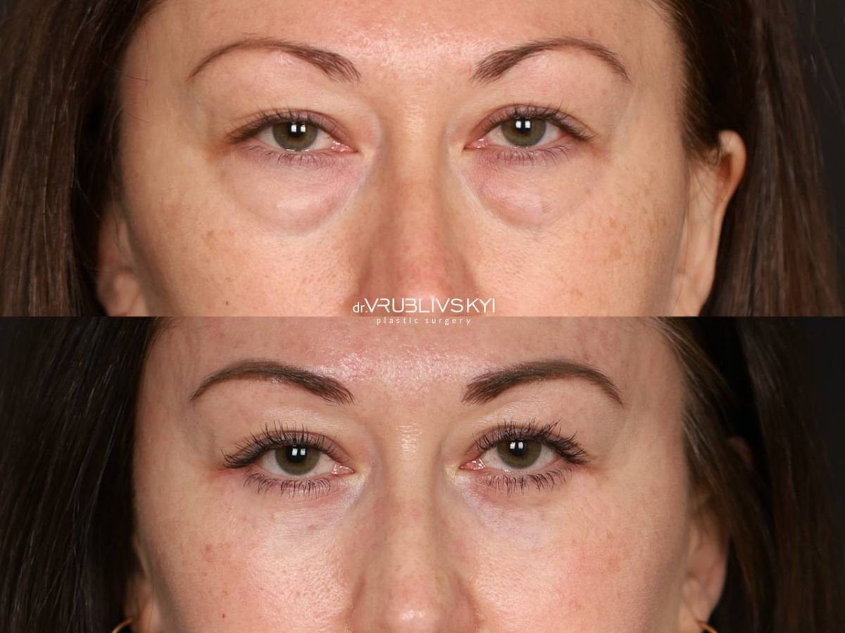 نتائج رأب الجفن قبل وبعد في Dr. VRUBLIVSKYI Plastic Surgery، تصحيح الجفون
