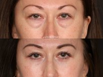 Before and after blepharoplasty results at Dr. VRUBLIVSKYI Plastic Surgery, eyelid correction