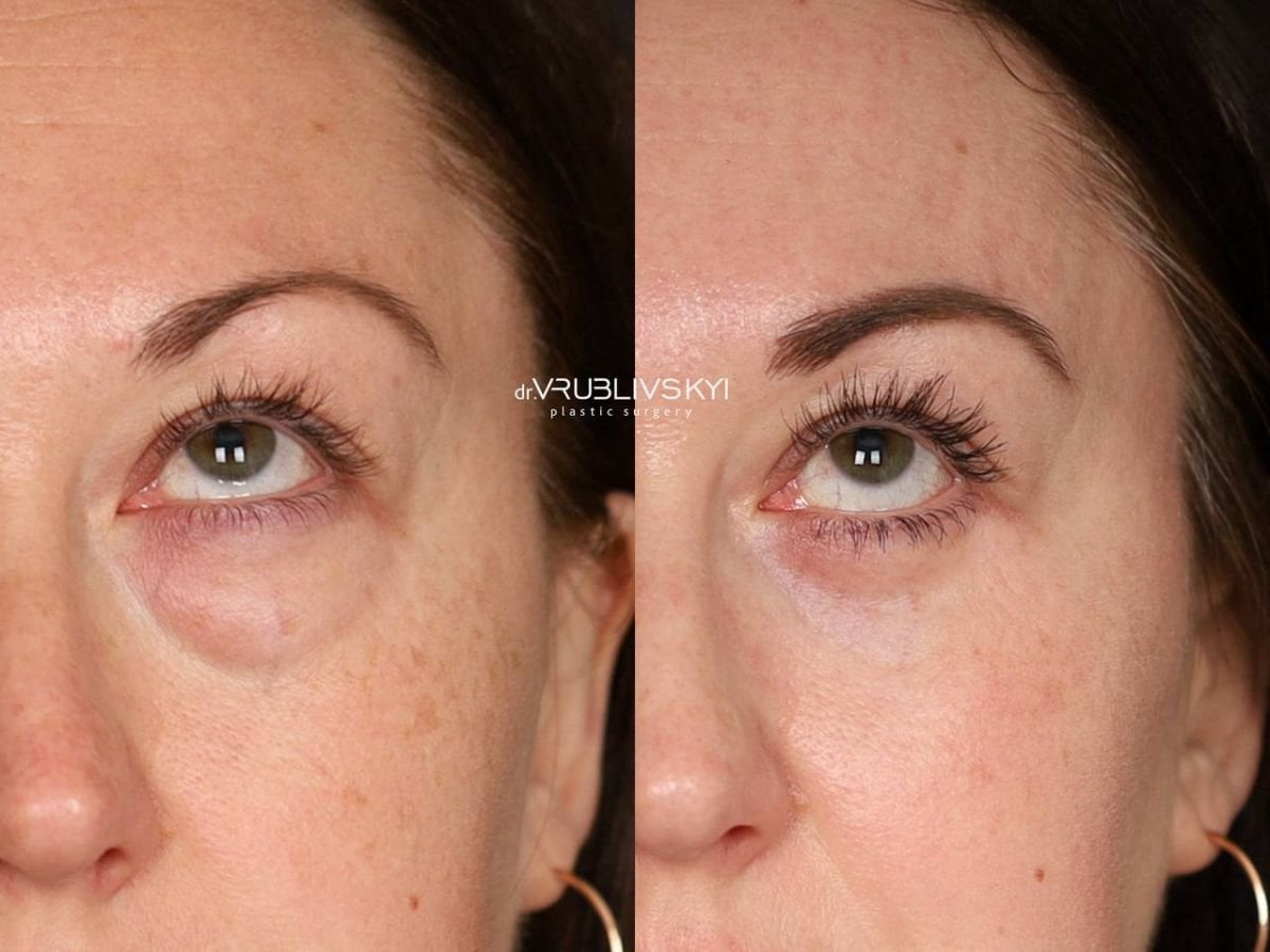 نتائج رأب الجفن قبل وبعد في Dr. VRUBLIVSKYI Plastic Surgery، تصحيح الجفون