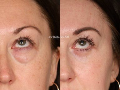 Before and after blepharoplasty results at Dr. VRUBLIVSKYI Plastic Surgery, eyelid correction