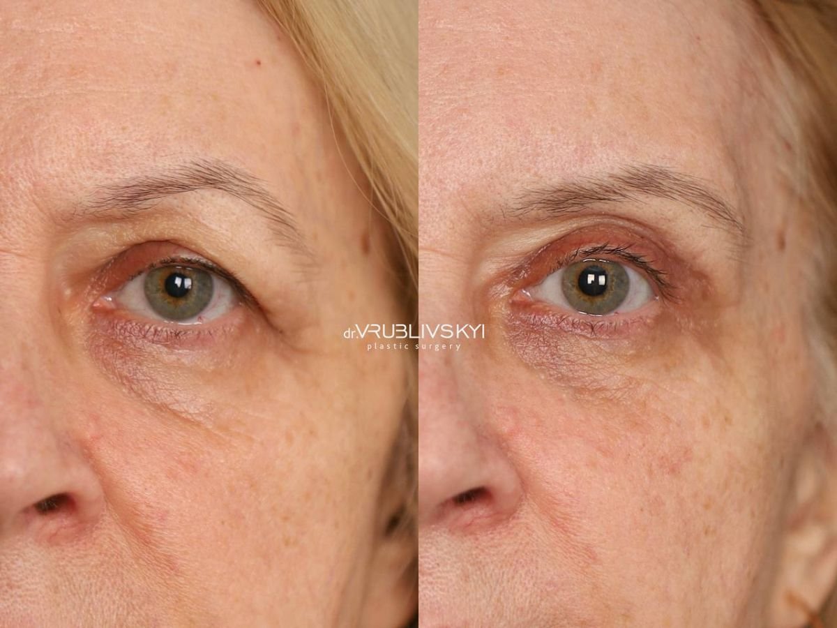 نتائج رأب الجفن قبل وبعد في Dr. VRUBLIVSKYI Plastic Surgery، تصحيح الجفون