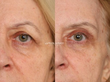 Before and after blepharoplasty results at Dr. VRUBLIVSKYI Plastic Surgery, eyelid correction