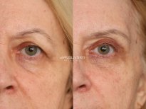 Before and after blepharoplasty results at Dr. VRUBLIVSKYI Plastic Surgery, eyelid correction