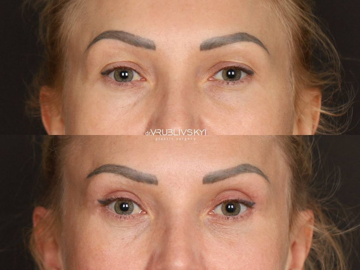 Resultados de blefaroplastia antes y después en Dr. VRUBLIVSKYI Plastic Surgery, corrección de párpados