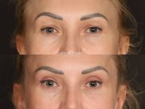 Blepharoplasty before and after results at Dr. VRUBLIVSKYI Plastic Surgery, eyelid correction