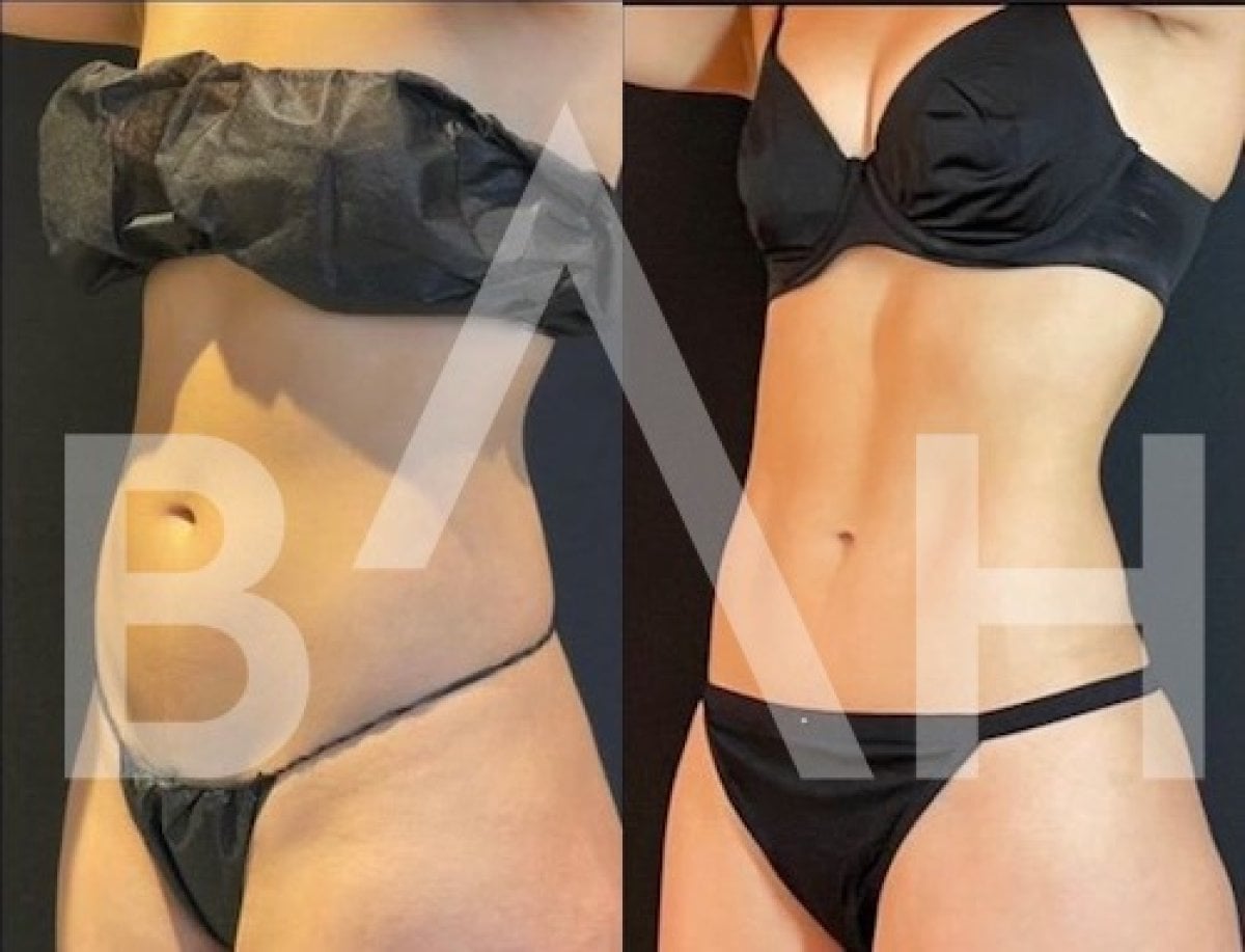 Resultados de abdominoplastia y liposucción antes y después en Büyük Anadolu Hospitals (BAH)