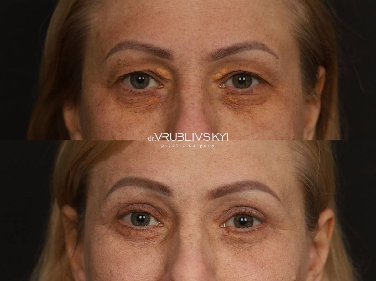 Результаты блефаропластики до и после в Dr. VRUBLIVSKYI Plastic Surgery, коррекция век