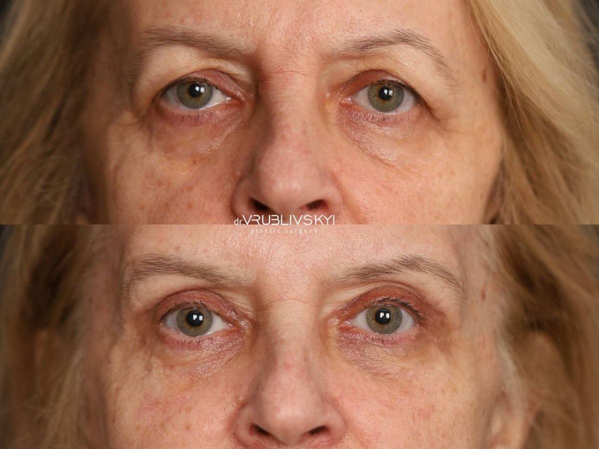 Результаты блефаропластики до и после в Dr. VRUBLIVSKYI Plastic Surgery, коррекция век