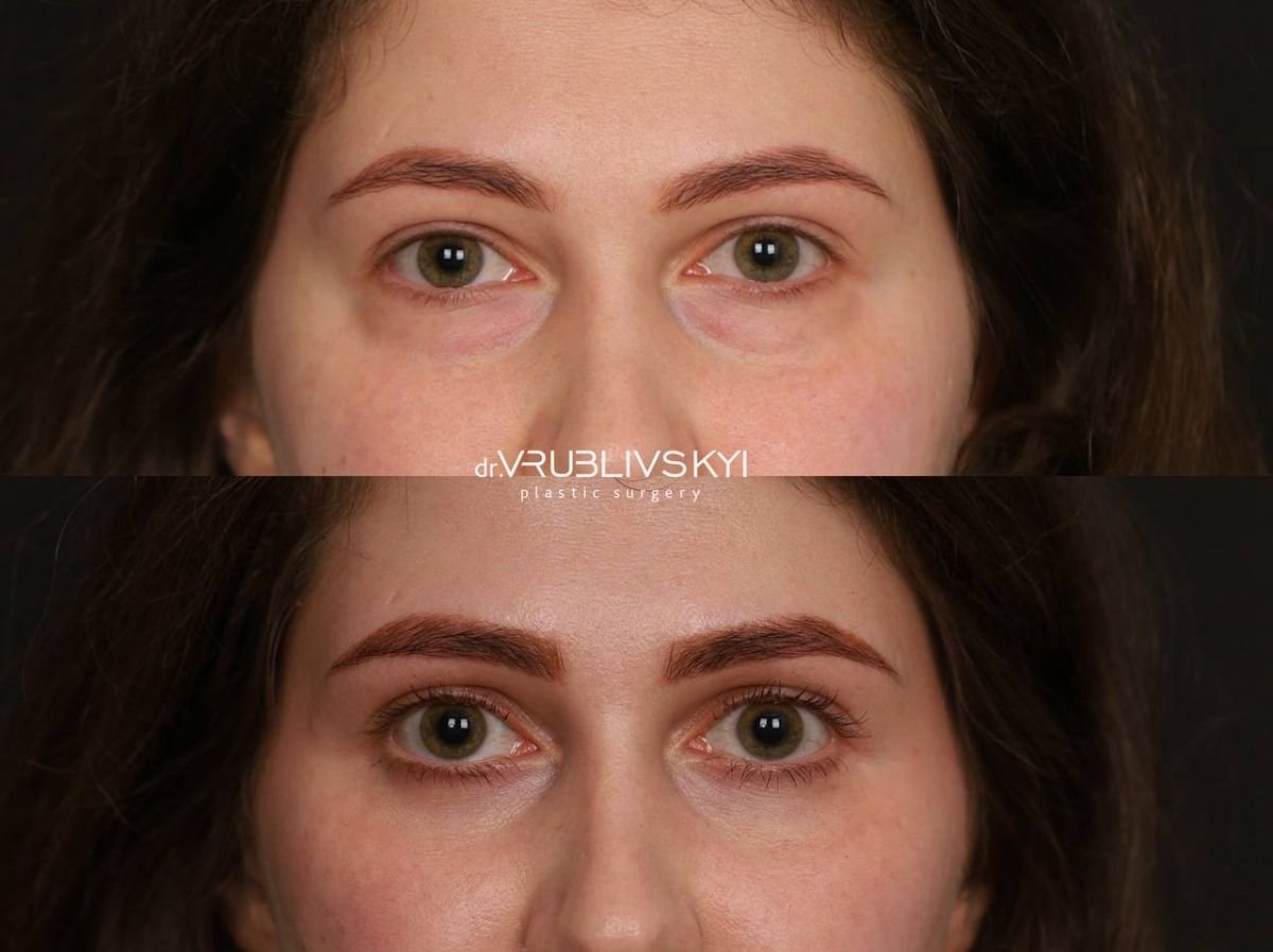 Результаты блефаропластики до и после в Dr. VRUBLIVSKYI Plastic Surgery, коррекция век