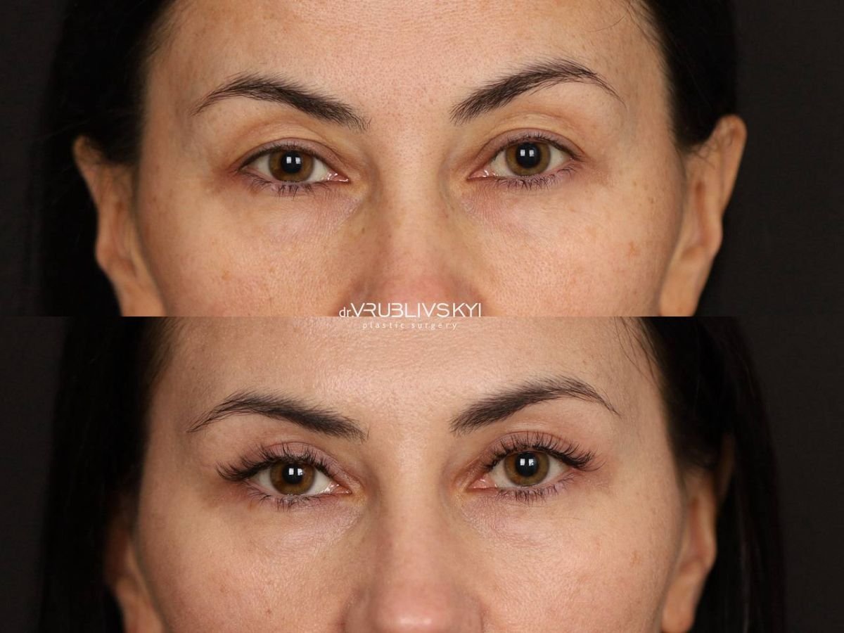 Результаты блефаропластики до и после в Dr. VRUBLIVSKYI Plastic Surgery, коррекция век
