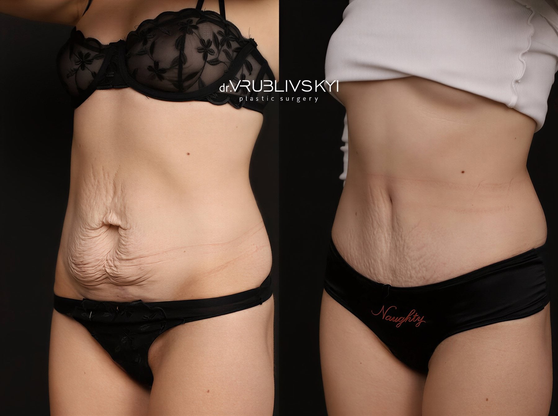 Resultados de abdominoplastia antes y después en Dr. VRUBLIVSKYI Plastic Surgery, abdomen plano
