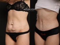 Before and after tummy tuck results at Dr. VRUBLIVSKYI Plastic Surgery, flatter abdomen