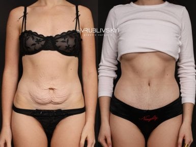 Before and after tummy tuck results at Dr. VRUBLIVSKYI Plastic Surgery, improved abdomen contour