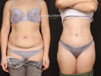 Résultats avant-après abdominoplastie chez Dr. VRUBLIVSKYI Plastic Surgery, ventre plat
