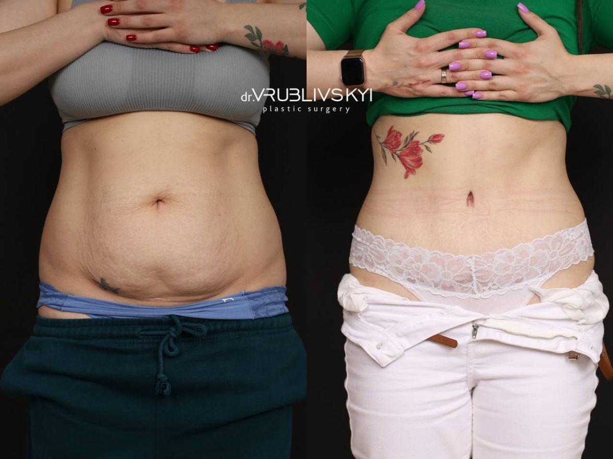 Результати до і після абдомінопластики в Dr. VRUBLIVSKYI Plastic Surgery, плоский живіт