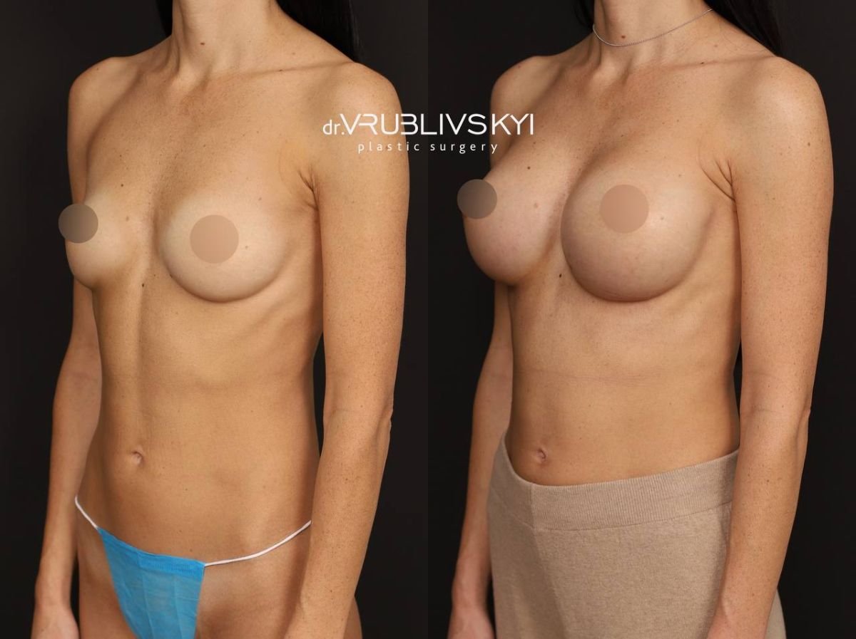 نتائج قبل وبعد عملية تكبير الثدي في Dr. VRUBLIVSKYI Plastic Surgery