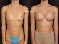 Результаты маммопластики до и после в Dr. VRUBLIVSKYI Plastic Surgery, увеличение груди