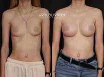 Результаты маммопластики до и после в Dr. VRUBLIVSKYI Plastic Surgery, увеличение груди