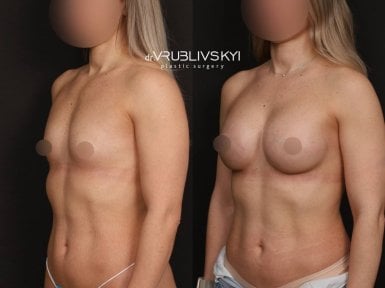 نتائج عملية تكبير الثدي قبل وبعد في Dr. VRUBLIVSKYI Plastic Surgery