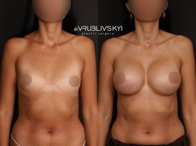 نتائج عملية تكبير الثدي قبل وبعد في Dr. VRUBLIVSKYI Plastic Surgery