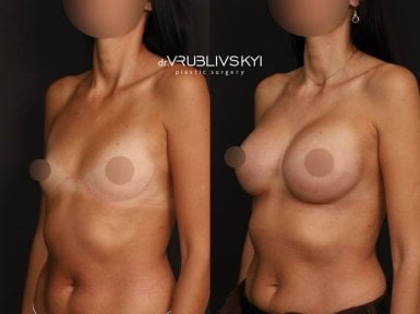 نتائج عملية تكبير الثدي قبل وبعد في Dr. VRUBLIVSKYI Plastic Surgery