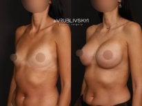 نتائج عملية تكبير الثدي قبل وبعد في Dr. VRUBLIVSKYI Plastic Surgery