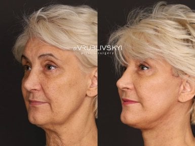 Результати до і після підтяжки обличчя в Dr. VRUBLIVSKYI Plastic Surgery, омолодження