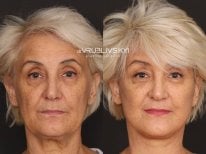 Facelift before and after results at Dr. VRUBLIVSKYI Plastic Surgery, visible facial rejuvenation
