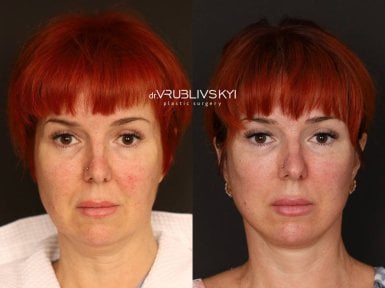 Результати до і після підтяжки обличчя в Dr. VRUBLIVSKYI Plastic Surgery, омолодження